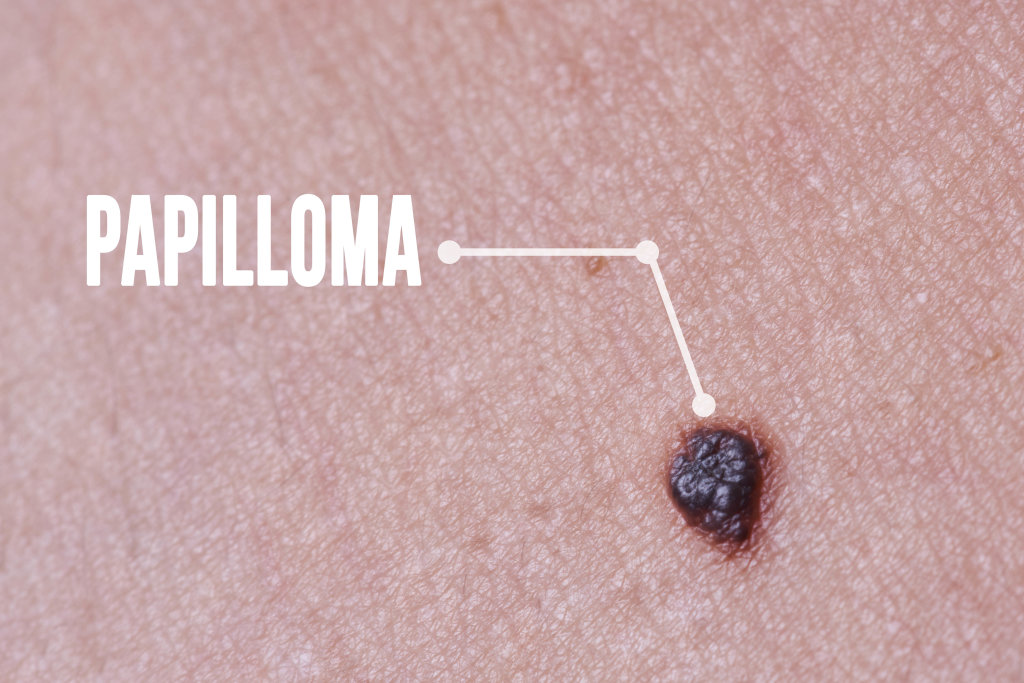 Macro of Papillomas or mole on female neck