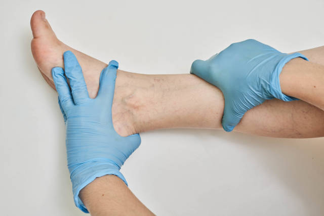 Hands of doctor examine varicose veins on female leg
